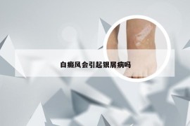 白癜风会引起银屑病吗