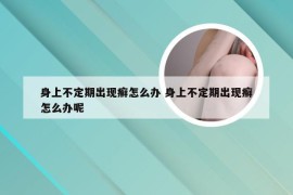 身上不定期出现癣怎么办 身上不定期出现癣怎么办呢