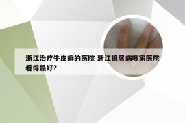 浙江治疗牛皮癣的医院 浙江银屑病哪家医院看得最好?