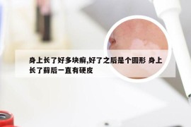 身上长了好多块癣,好了之后是个圆形 身上长了藓后一直有硬皮