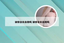 缺锌会长白斑吗 缺锌会长白斑吗