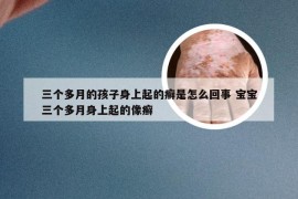 三个多月的孩子身上起的癣是怎么回事 宝宝三个多月身上起的像癣