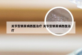 关节型银屑病西医治疗 关节型银屑病西医治疗