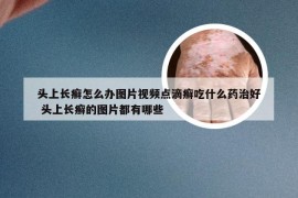 头上长癣怎么办图片视频点滴癣吃什么药治好 头上长癣的图片都有哪些