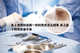 身上有类似皮癣一样的死皮怎么回事 身上起了和死皮差不多