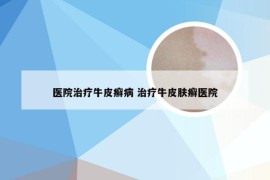 医院治疗牛皮癣病 治疗牛皮肤癣医院