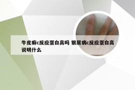 牛皮癣c反应蛋白高吗 银屑病c反应蛋白高说明什么