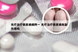 光疗治疗银屑病病例一 光疗治疗银屑病有副作用吗