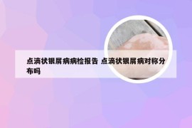 点滴状银屑病病检报告 点滴状银屑病对称分布吗