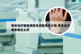 类克治疗银屑病类克进医保多少钱 类克治疗银屑病怎么样