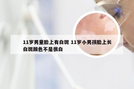 11岁男童脸上有白斑 11岁小男孩脸上长白斑颜色不是很白