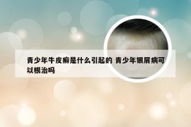 青少年牛皮癣是什么引起的 青少年银屑病可以根治吗