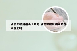 点滴型银屑病头上长吗 点滴型银屑病会长在头皮上吗