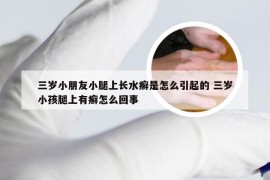 三岁小朋友小腿上长水癣是怎么引起的 三岁小孩腿上有癣怎么回事