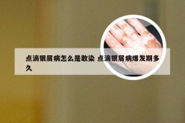 点滴银屑病怎么是敢染 点滴银屑病爆发期多久