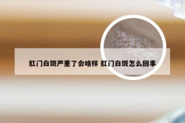 肛门白斑严重了会啥样 肛门白斑怎么回事