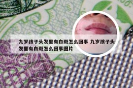 九岁孩子头发里有白斑怎么回事 九岁孩子头发里有白斑怎么回事图片