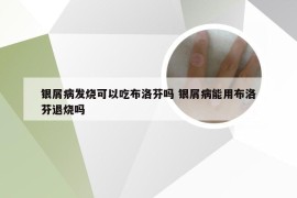 银屑病发烧可以吃布洛芬吗 银屑病能用布洛芬退烧吗