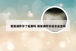 银屑病怀孕了能要吗 银屑病怀孕后会自愈吗