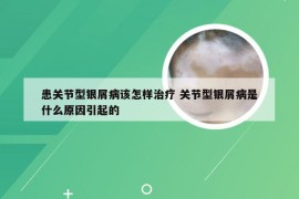 患关节型银屑病该怎样治疗 关节型银屑病是什么原因引起的