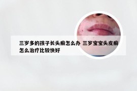 三岁多的孩子长头癣怎么办 三岁宝宝头皮癣怎么治疗比较快好