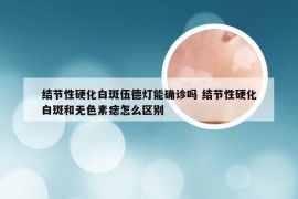 结节性硬化白斑伍德灯能确诊吗 结节性硬化白斑和无色素痣怎么区别