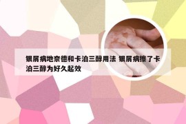 银屑病地奈德和卡泊三醇用法 银屑病擦了卡泊三醇为好久起效