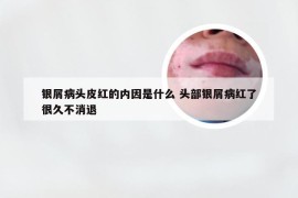 银屑病头皮红的内因是什么 头部银屑病红了很久不消退