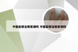 中医能根治银屑病吗 中医能根治银屑病吗