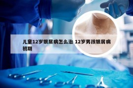 儿童12岁银屑病怎么治 12岁男孩银屑病初期