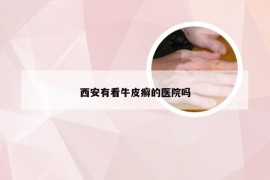 西安有看牛皮癣的医院吗