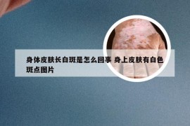 身体皮肤长白斑是怎么回事 身上皮肤有白色斑点图片