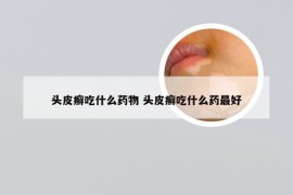 头皮癣吃什么药物 头皮癣吃什么药最好