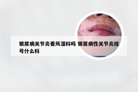 银屑病关节炎看风湿科吗 银屑病性关节炎挂号什么科