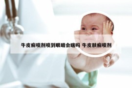 牛皮癣喷剂喷到眼睛会瞎吗 牛皮肤癣喷剂