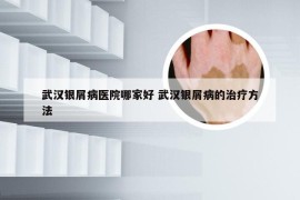 武汉银屑病医院哪家好 武汉银屑病的治疗方法