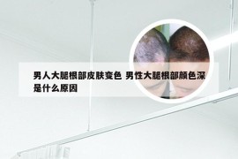 男人大腿根部皮肤变色 男性大腿根部颜色深是什么原因