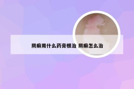 阴癣用什么药膏根治 阴癣怎么治