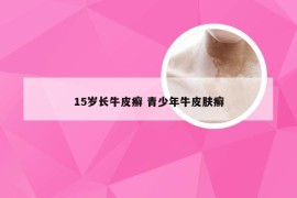 15岁长牛皮癣 青少年牛皮肤癣