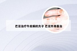 巴豆治疗牛皮癣的方子 巴豆外用善治