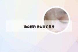 治白斑的 治白斑的费用