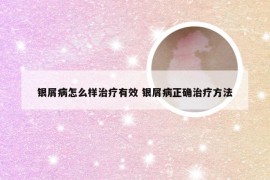 银屑病怎么样治疗有效 银屑病正确治疗方法