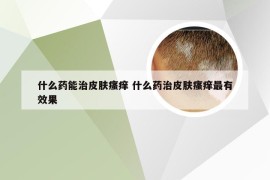 什么药能治皮肤瘙痒 什么药治皮肤瘙痒最有效果