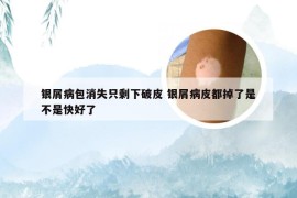 银屑病包消失只剩下破皮 银屑病皮都掉了是不是快好了