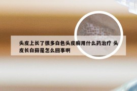 头皮上长了很多白色头皮癣用什么药治疗 头皮长白藓是怎么回事啊