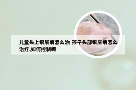 儿童头上银屑病怎么治 孩子头部银屑病怎么治疗,如何控制呢