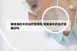 银屑病吃中药治疗管用吗 银屑病中药治疗效果好吗