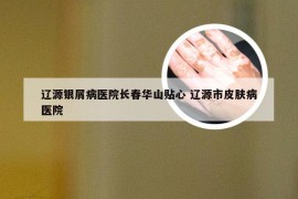 辽源银屑病医院长春华山贴心 辽源市皮肤病医院