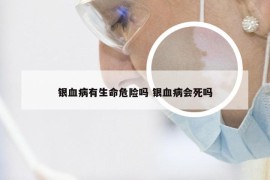 银血病有生命危险吗 银血病会死吗