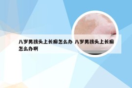 八岁男孩头上长癣怎么办 八岁男孩头上长癣怎么办啊